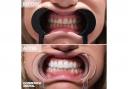 Figure 1. Turkey teeth - before and after results