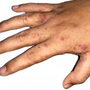 People with scabies are being warned by health experts to 